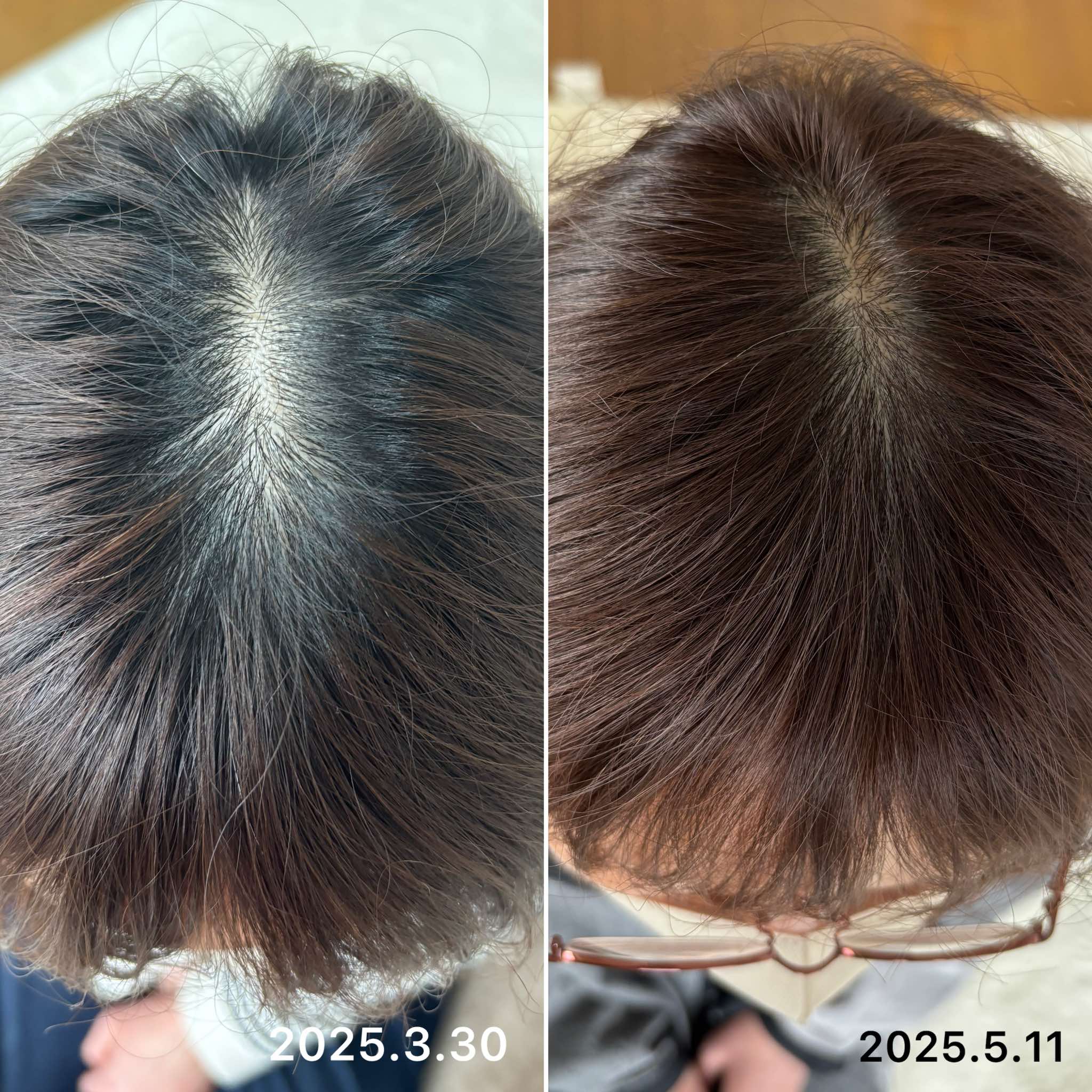 頭皮症例5